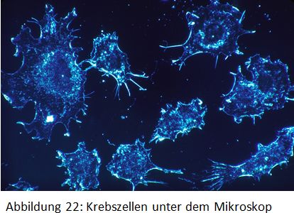 Krebszellen im Mikroskop